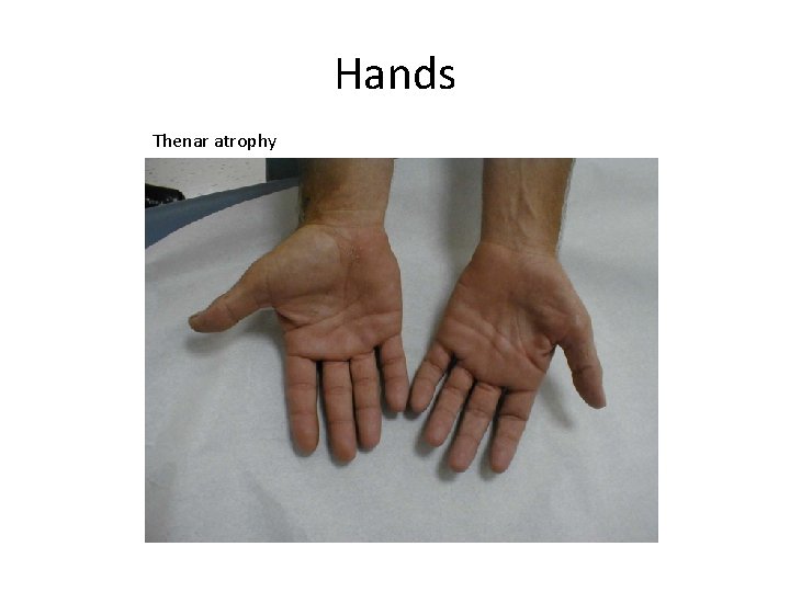 Hands Thenar atrophy 