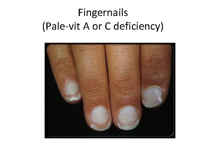 Fingernails (Pale-vit A or C deficiency) 