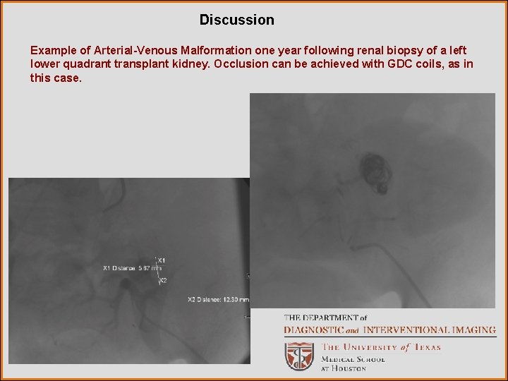 Discussion Example of Arterial-Venous Malformation one year following renal biopsy of a left lower