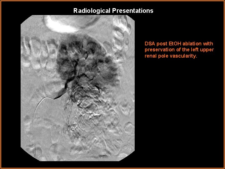 Radiological Presentations DSA post Et. OH ablation with preservation of the left upper renal