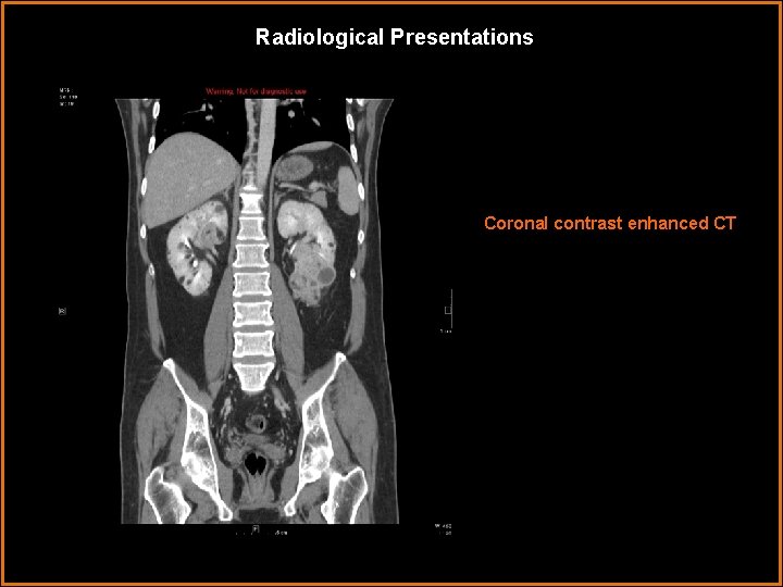 Radiological Presentations Coronal contrast enhanced CT 