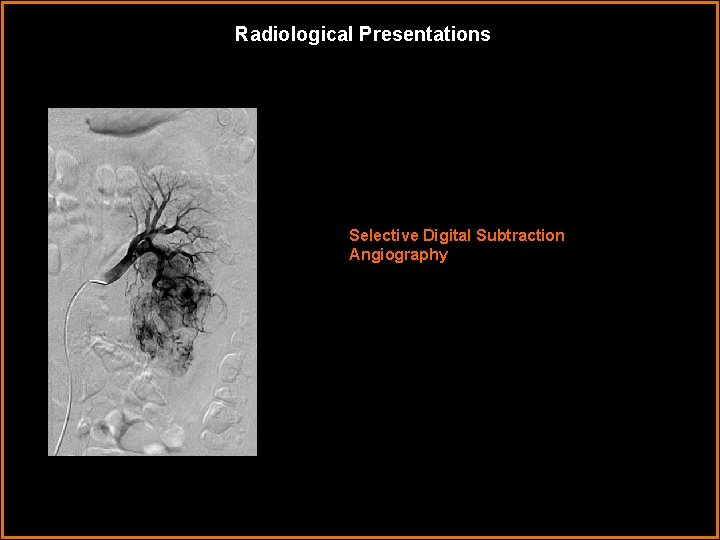Radiological Presentations Selective Digital Subtraction Angiography 