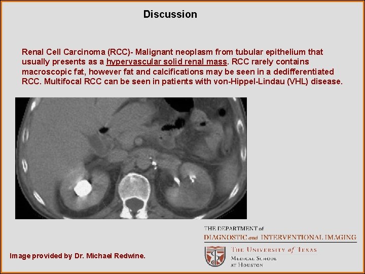 Discussion Renal Cell Carcinoma (RCC)- Malignant neoplasm from tubular epithelium that usually presents as
