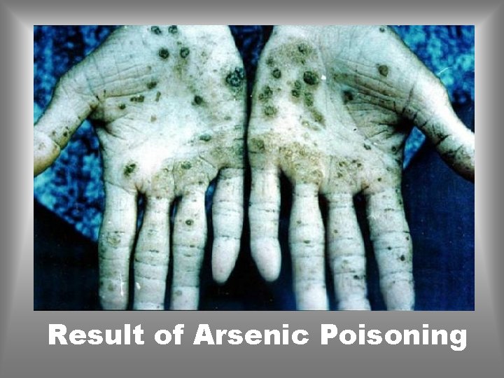 Result of Arsenic Poisoning 