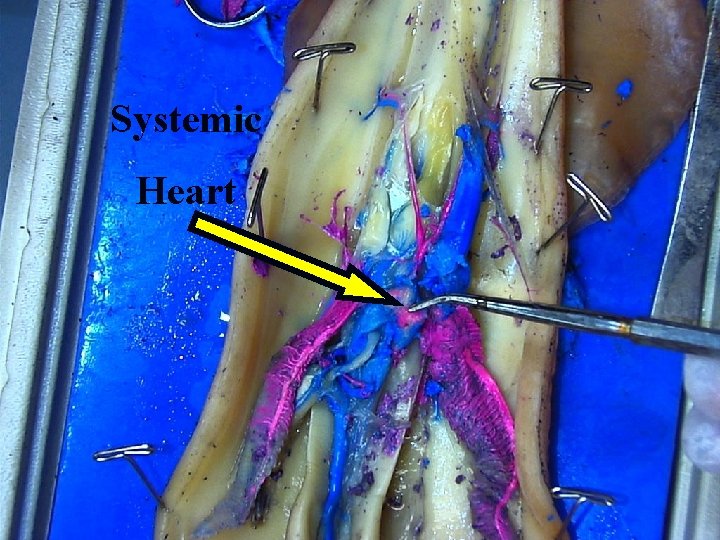 Systemic Heart 