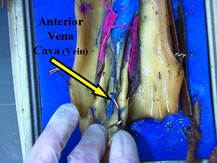 Anterior Vena Cava (Vein) 