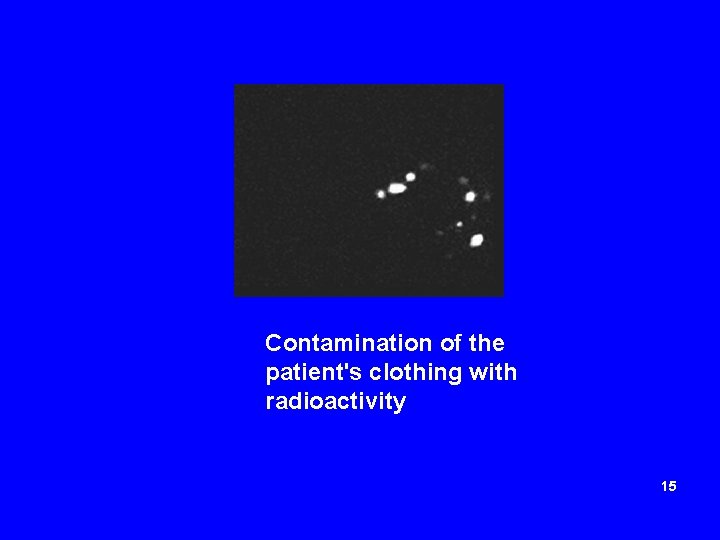 Contamination of the patient's clothing with radioactivity 15 