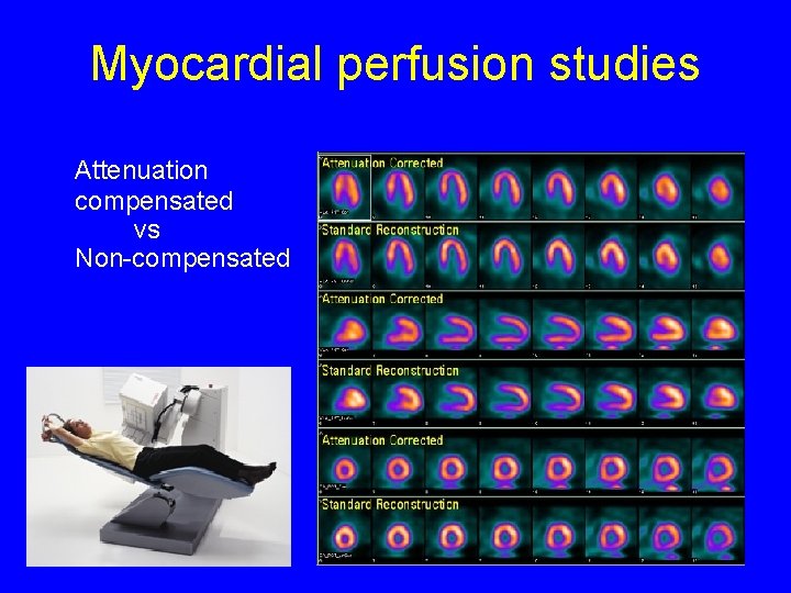 Myocardial perfusion studies Attenuation compensated vs Non-compensated 16 