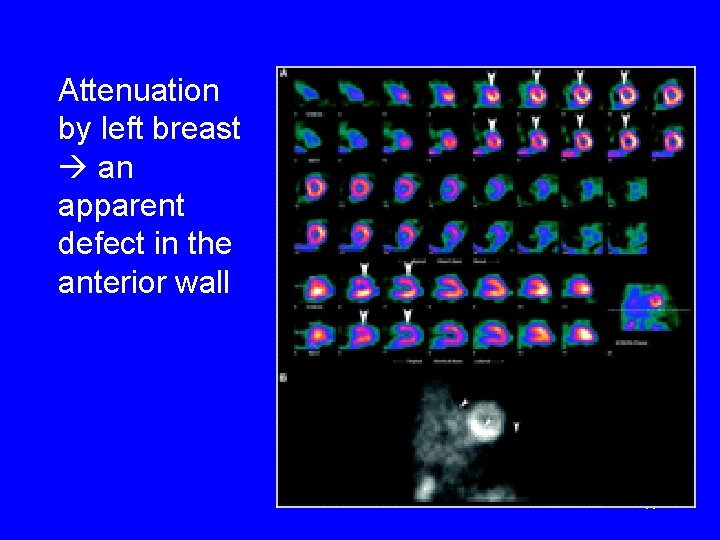 Attenuation by left breast an apparent defect in the anterior wall 17 