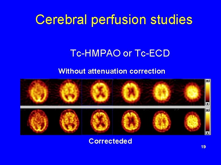 Cerebral perfusion studies Tc-HMPAO or Tc-ECD Without attenuation correction Correcteded 19 