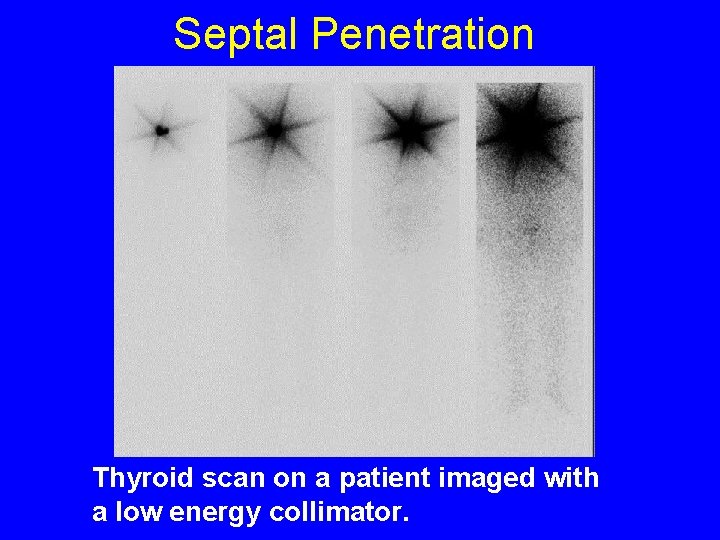 Septal Penetration Thyroid scan on a patient imaged with a low energy collimator. 