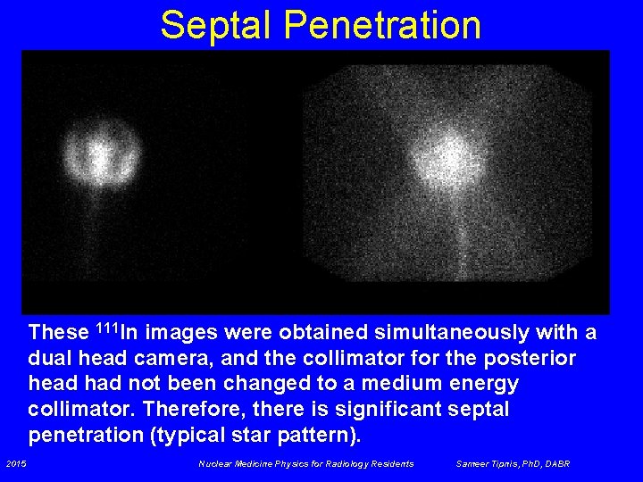 Septal Penetration These 111 In images were obtained simultaneously with a dual head camera,