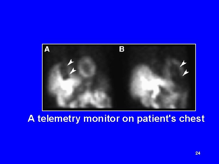 A telemetry monitor on patient's chest 24 