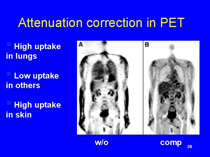 Attenuation correction in PET § High uptake in lungs § Low uptake in others