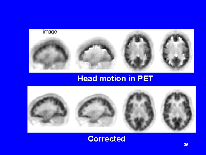 Head motion in PET Corrected 35 