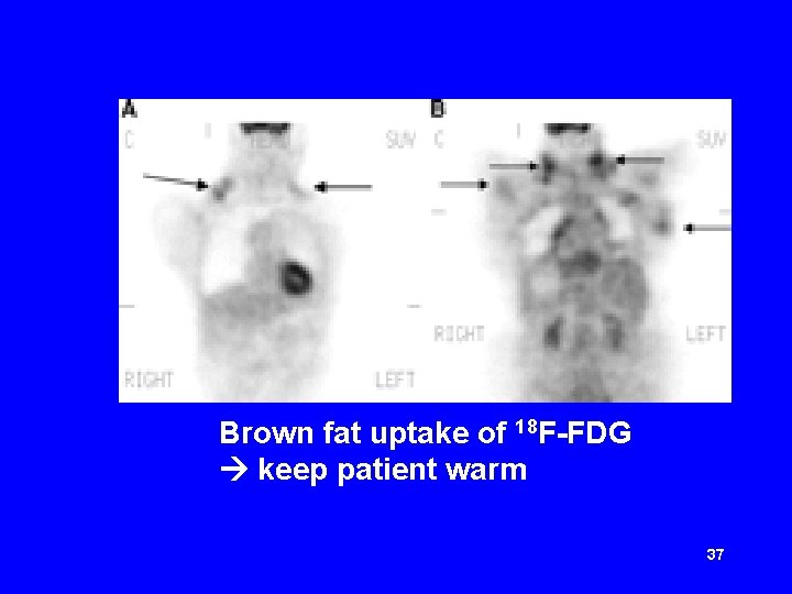 Brown fat uptake of 18 F-FDG keep patient warm 37 
