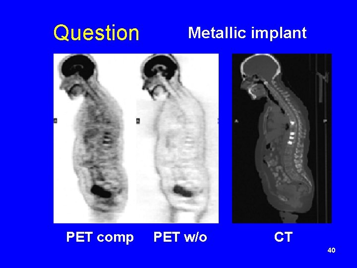 Question PET comp Metallic implant PET w/o CT 40 