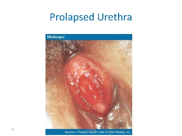 Prolapsed Urethra 13 Group A 