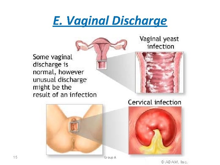 E. Vaginal Discharge 15 Group A 