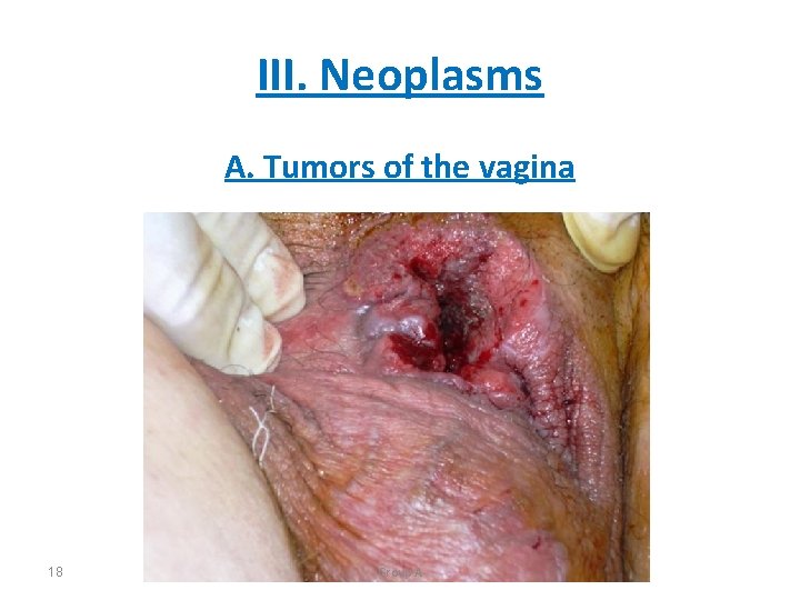 III. Neoplasms A. Tumors of the vagina 18 Group A 