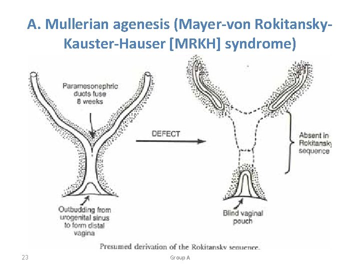 A. Mullerian agenesis (Mayer-von Rokitansky. Kauster-Hauser [MRKH] syndrome) 23 Group A 