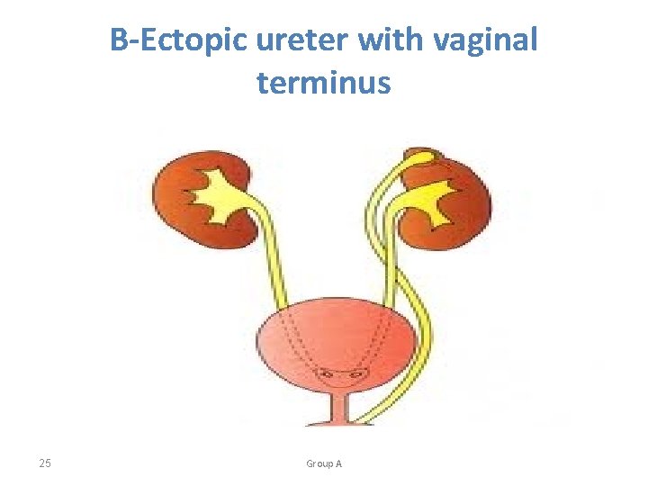 B-Ectopic ureter with vaginal terminus 25 Group A 