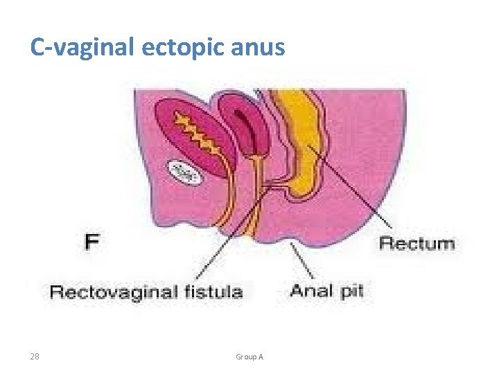 C-vaginal ectopic anus 28 Group A 