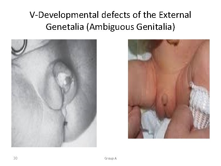 V-Developmental defects of the External Genetalia (Ambiguous Genitalia) 30 Group A 