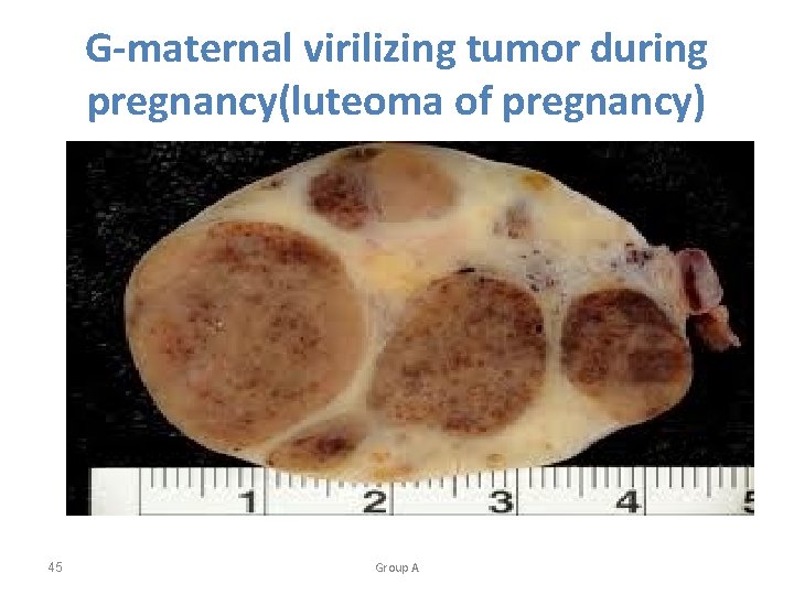 G-maternal virilizing tumor during pregnancy(luteoma of pregnancy) 45 Group A 