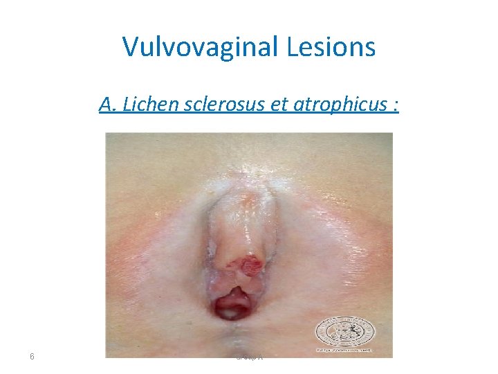 Vulvovaginal Lesions A. Lichen sclerosus et atrophicus : 6 Group A 