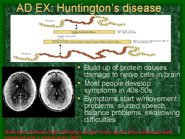 AD EX: Huntington’s disease • Build up of protein causes damage to nerve cells