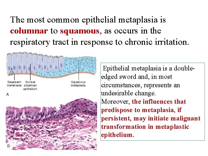 The most common epithelial metaplasia is columnar to squamous, as occurs in the respiratory