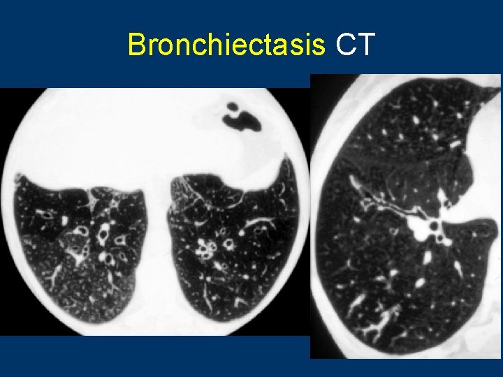 Bronchiectasis CT 14 