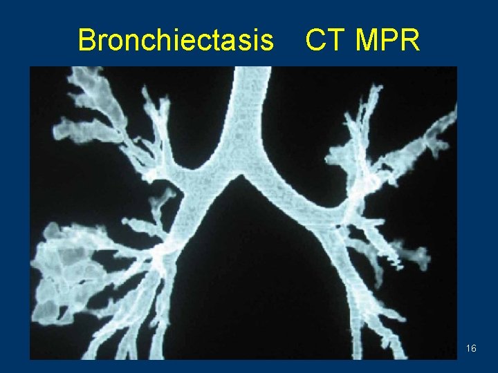 Bronchiectasis CT MPR 16 