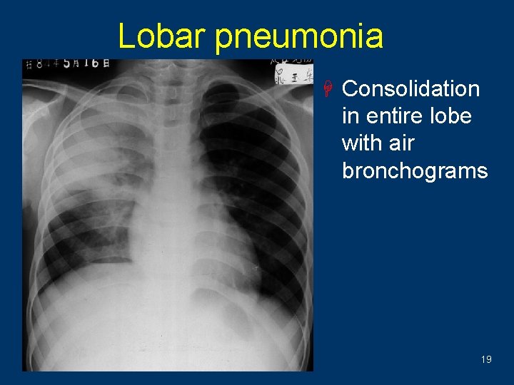 Lobar pneumonia H Consolidation in entire lobe with air bronchograms 19 