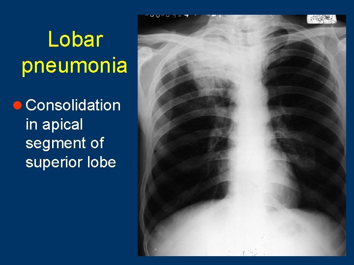 Lobar pneumonia l Consolidation in apical segment of superior lobe 20 