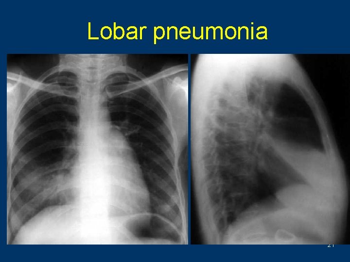 Lobar pneumonia 21 