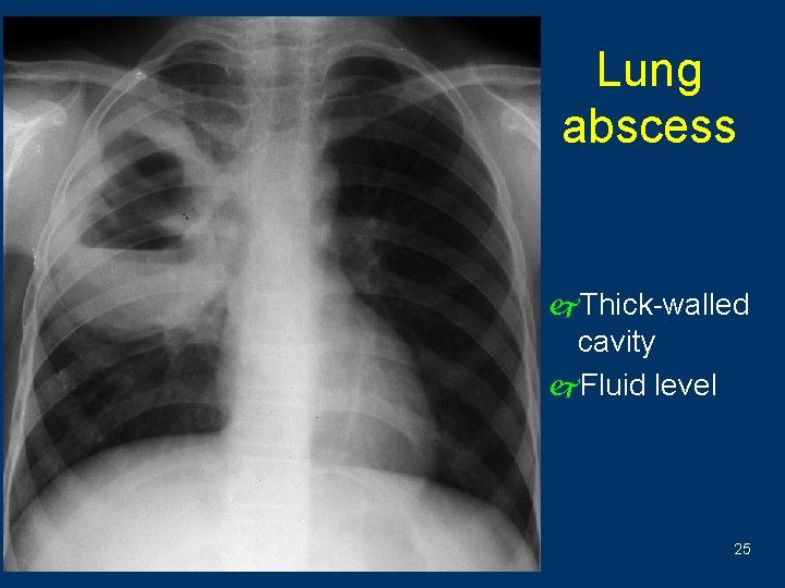 Lung abscess j. Thick-walled cavity j. Fluid level 25 
