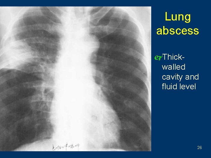 Lung abscess j. Thickwalled cavity and fluid level 26 