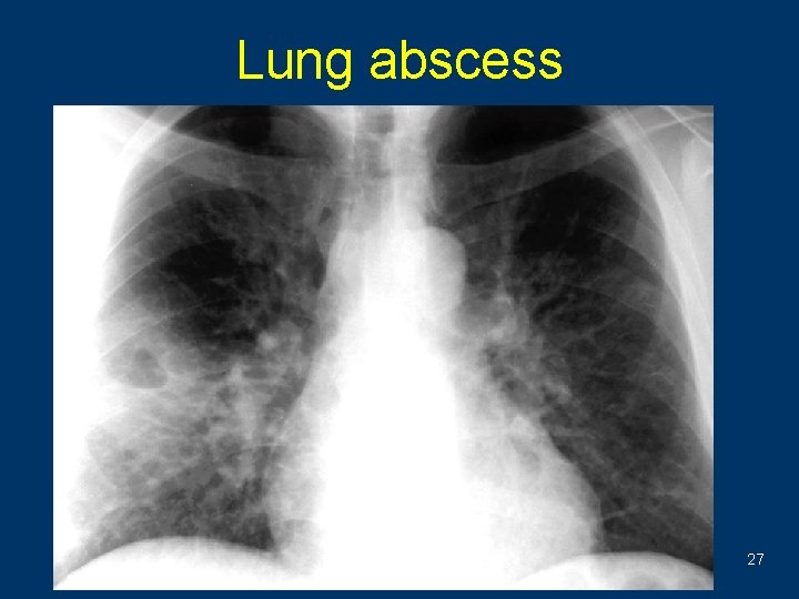 Lung abscess 27 