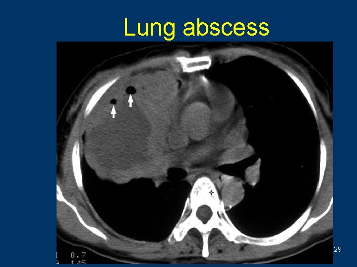 Lung abscess 29 