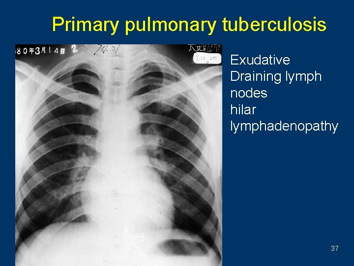 Primary pulmonary tuberculosis • Exudative • Draining lymph nodes • hilar lymphadenopathy 37 