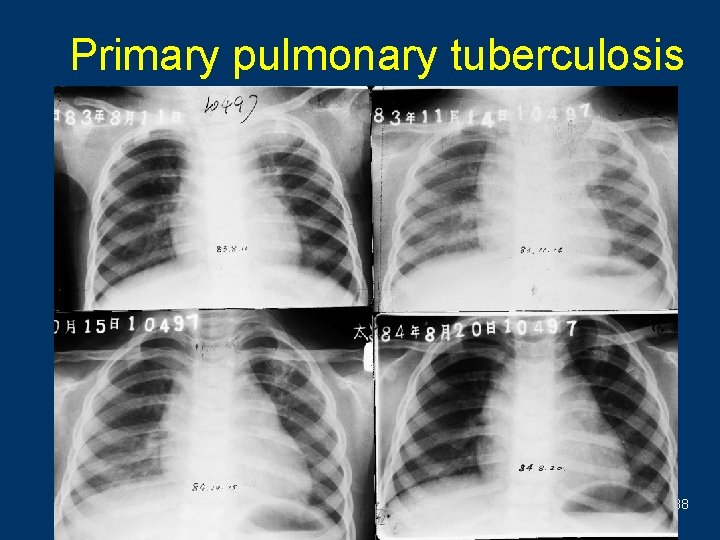 Primary pulmonary tuberculosis 38 