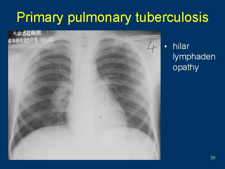 Primary pulmonary tuberculosis • hilar lymphaden opathy 39 