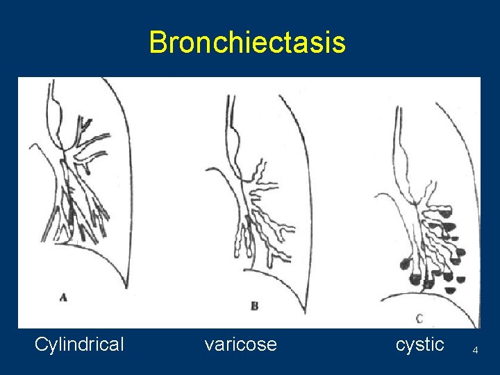 Bronchiectasis Cylindrical varicose cystic 4 