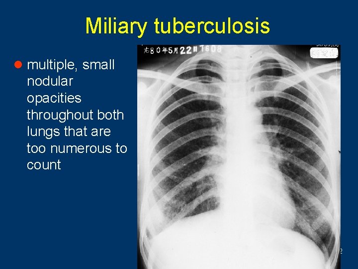 Miliary tuberculosis l multiple, small nodular opacities throughout both lungs that are too numerous