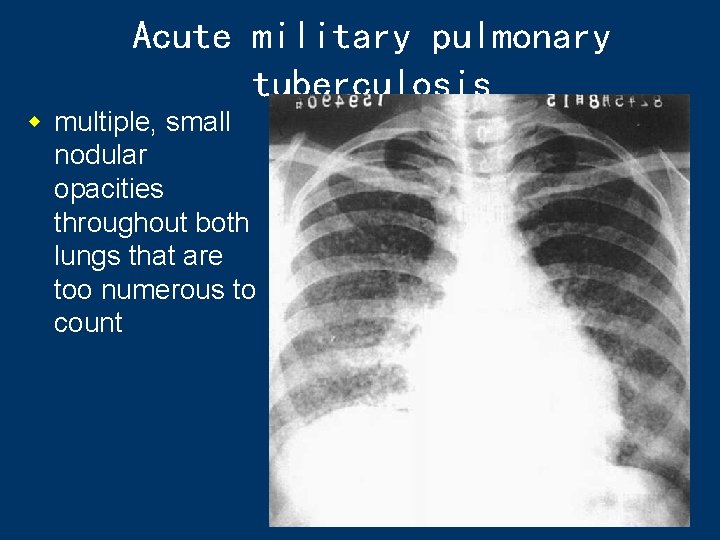 Acute military pulmonary tuberculosis w multiple, small nodular opacities throughout both lungs that are