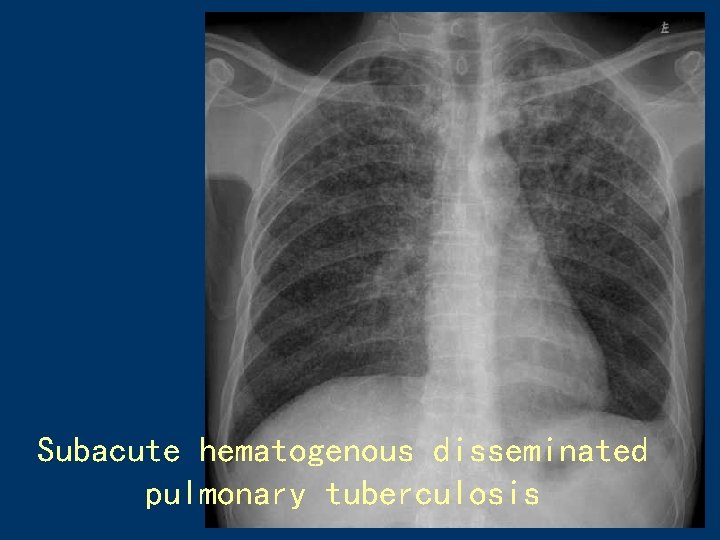 Subacute hematogenous disseminated pulmonary tuberculosis 44 