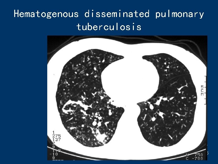 Hematogenous disseminated pulmonary tuberculosis 45 