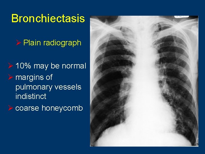 Bronchiectasis Ø Plain radiograph Ø 10% may be normal Ø margins of pulmonary vessels